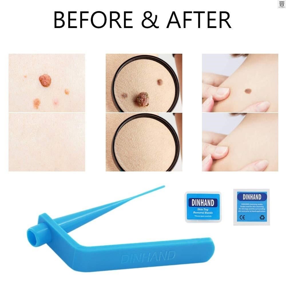 Skin tag removal band tool for 4–6 mm skin tags with cotton accessories