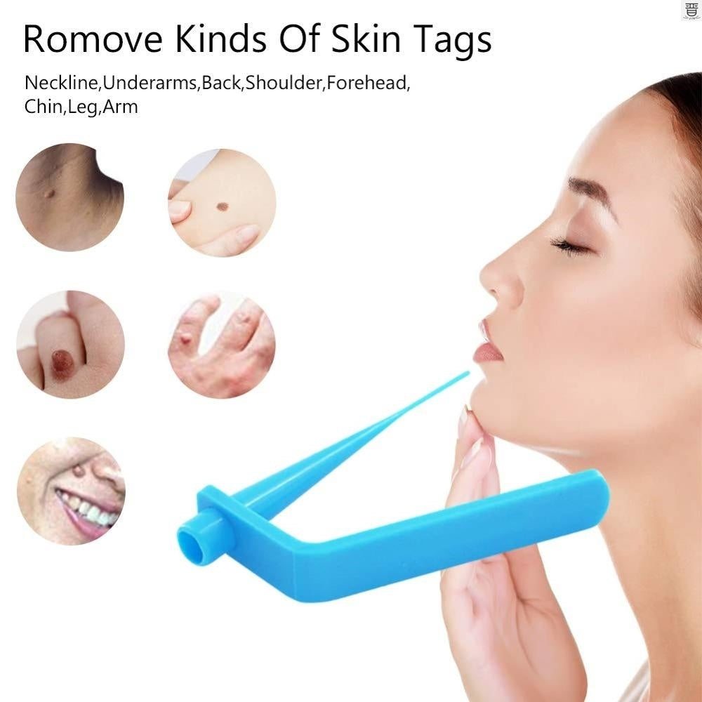 Skin tag removal band tool for 4–6 mm skin tags with cotton accessories